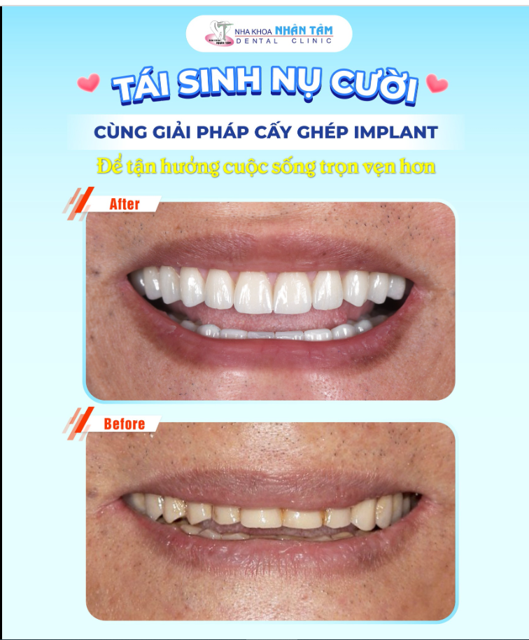 Ở tuổi 80, Khách hàng L. T. T (TP.HCM) hạnh phúc hơn khi có được hàm răng chắc khỏe để ăn nhai ngon miệng hơn, sức khỏe cũng được cải thiện.