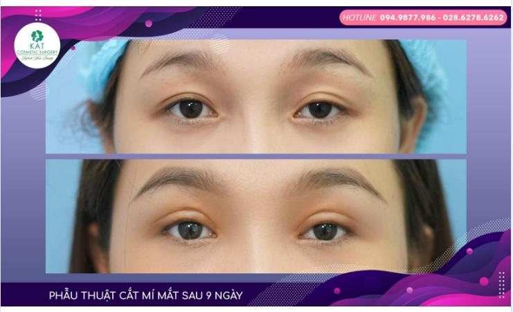 Phẫu thuật cắt mí mắt trên tại KAT đã giúp bạn tạm biệt đôi mắt buồn, không nếp mí và trao lại cho bạn một đôi mắt thật tròn xinh .