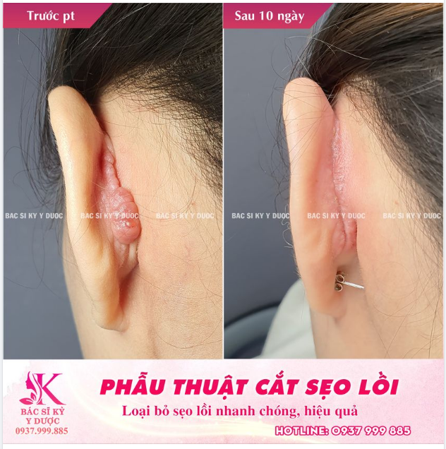 Phẫu thuật cắt sẹo lồi tại bác Sĩ Kỳ Y Dược