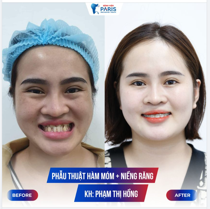 PHẪU THUẬT HÀM MÓM TẠI NHA KHOA PARIS