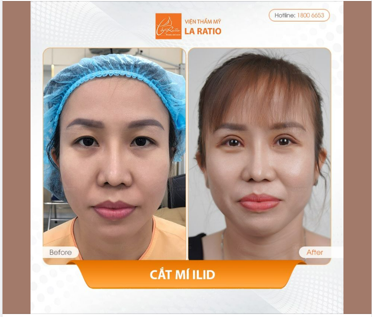 Phương pháp cắt mí iLid giúp khắc phục tất cả các nhược điểm về mắt.