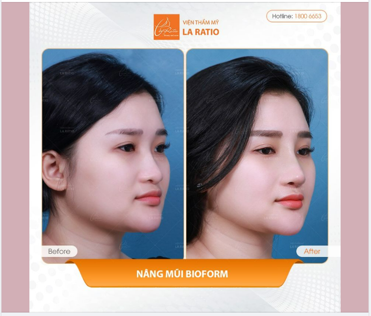 Phương pháp chỉnh hình dáng mũi độc quyền nhận được nhiều sự quan tâm của khách hàng.