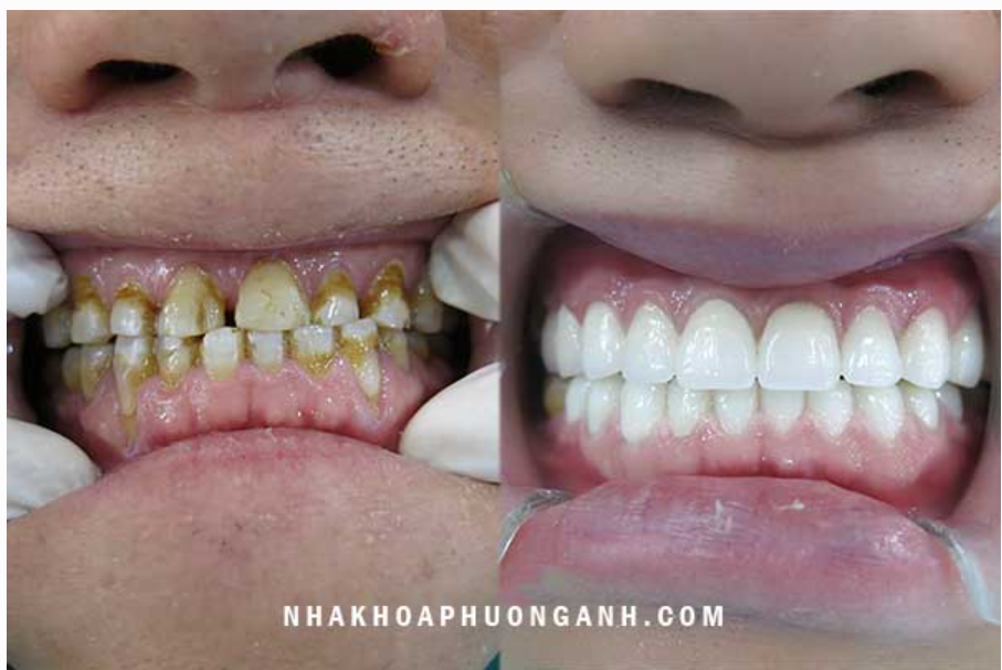 Phương pháp làm răng dài nào được áp dụng phổ biến hiện nay?