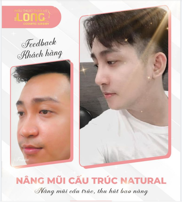 PHƯƠNG PHÁP NÂNG MŨI DÀNG CHO NAM GIỚI