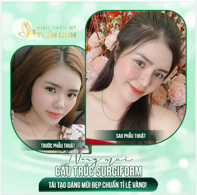 Phương pháp nâng mũi được các chuyên gia khuyên dùng với các ưu điểm vượt trội như