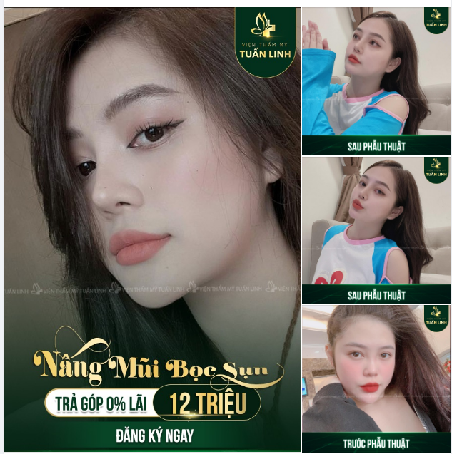  Phương pháp này chỉ phù hợp cho mũi không quá nhiều khuyết điểm, chỉ thiếu chiều cao sống mũi.