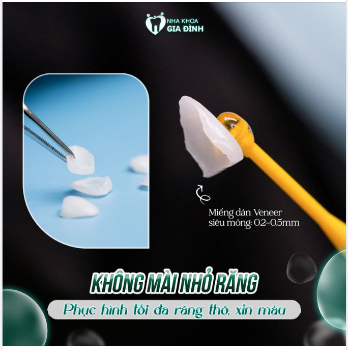 PHƯƠNG PHÁP THẨM MỸ RĂNG SỨ AN TOÀN, KHÔNG MÀI NHỎ RĂNG