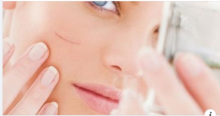 Phương pháp tiêm thuốc trong sẹo là một trong những cách điều trị sẹo lồi, sẹo phì đại tương đối hiệu quả và ít tốn kém.