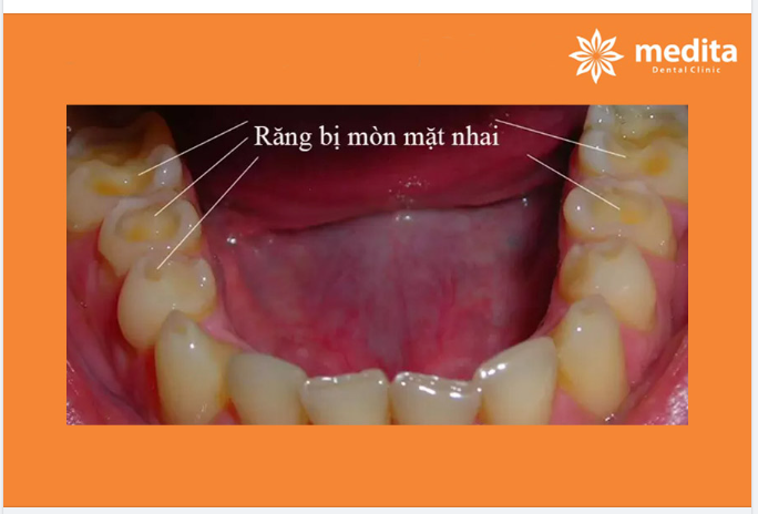 RĂNG BỊ MÒN MẶT NHAI