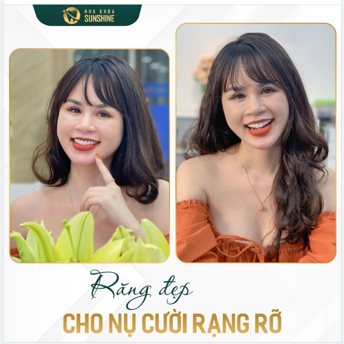 RĂNG ĐẸP CHO NỤ CƯỜI RẠNG RỠ