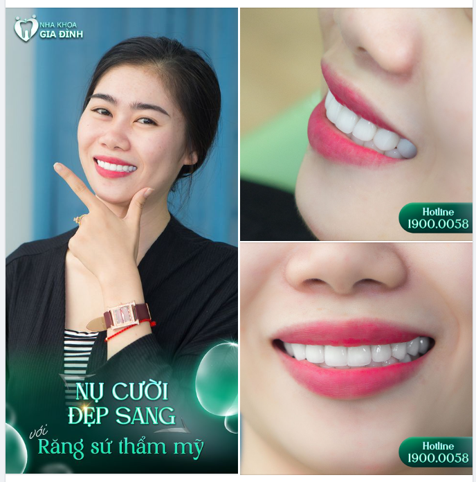 RĂNG ĐỀU TRẮNG SÁNG - NỤ CƯỜI TỰ KHẮC TỎA SÁNG