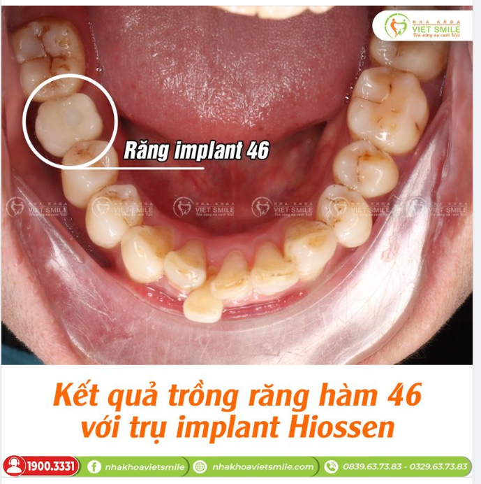 KẾT QUẢ TRỒNG RĂNG HÀM 46 VỚI TRỤ IMPLANT HIOSSEN