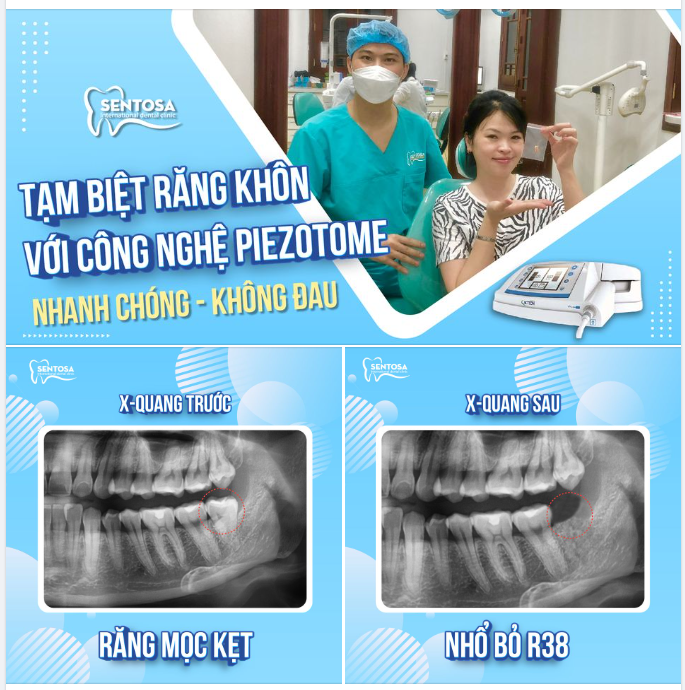 RĂNG KHÔN "MỌC DẠI" - CHỚ ĐỂ LÂU NGÀY