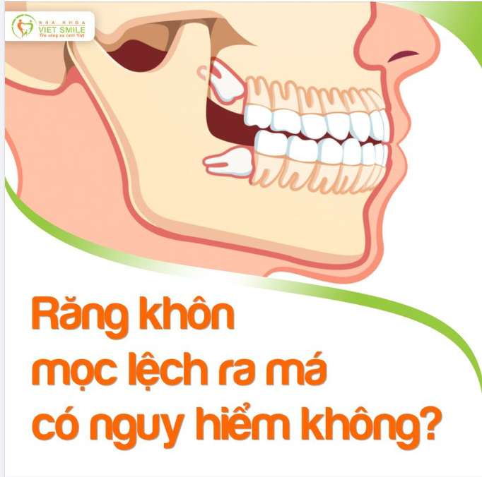 RĂNG KHÔN MỌC LỆCH MÁ CÓ NGUY HIỂM KHÔNG?