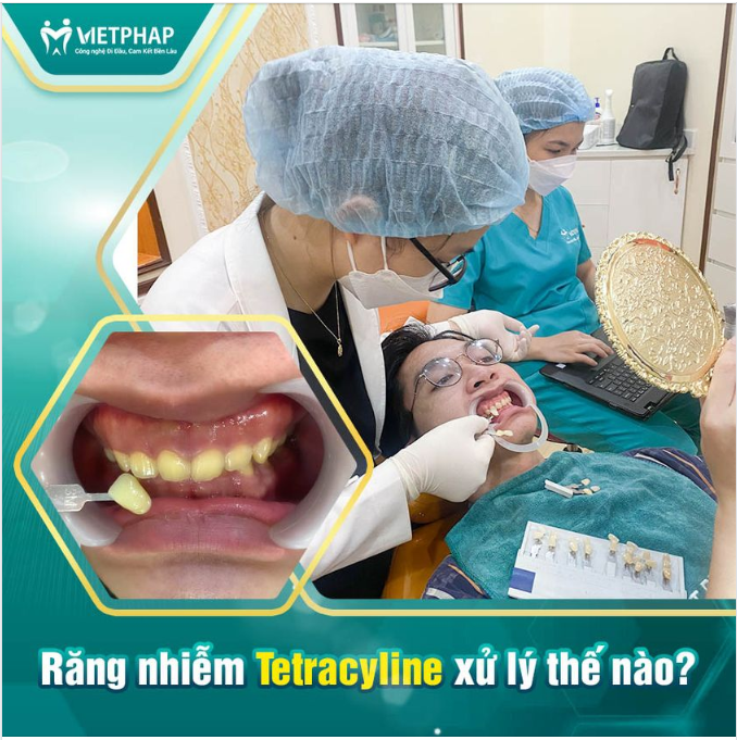 RĂNG NHIỄM TETRACYLINE CÓ TẨY TRẮNG ĐƯỢC KHÔNG?