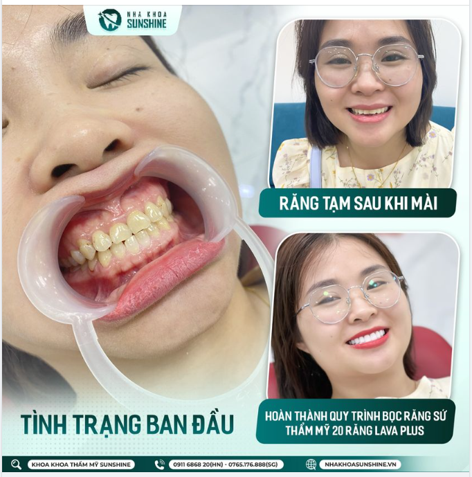 RĂNG SAU KHI MÀI CÓ ĂN UỐNG ĐƯỢC KHÔNG