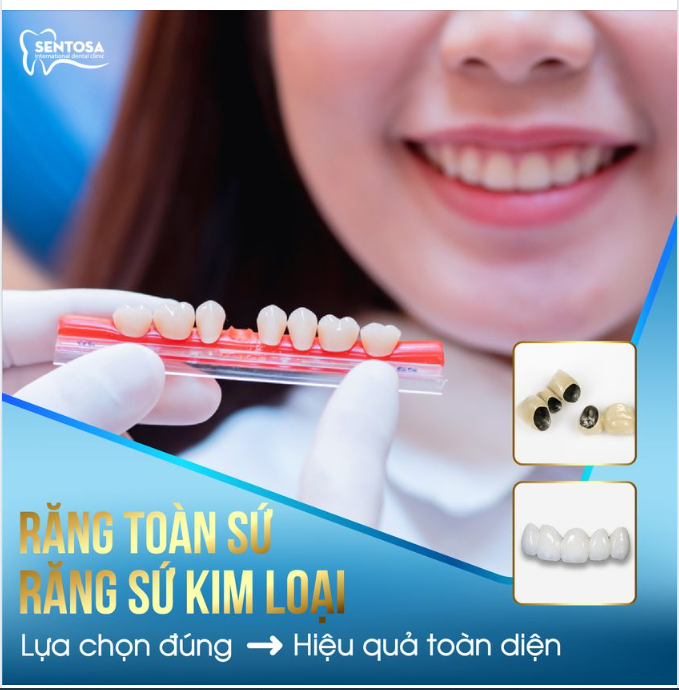 Răng sứ kim loại và Răng toàn sứ: Lựa chọn nào thích hợp và mang đến hiệu quả toàn diện?