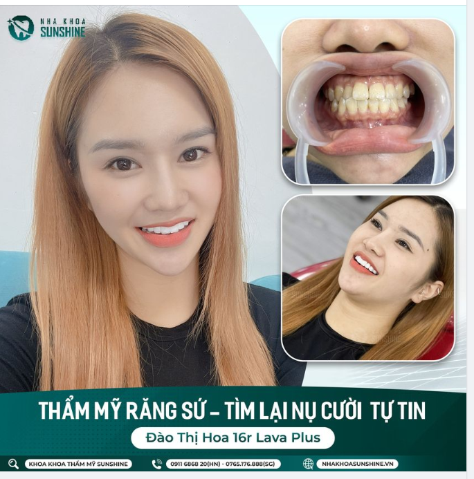 Răng sứ thẩm mỹ - Món quà ý nghĩa nhất dành tặng cho người phụ nữ mình yêu.