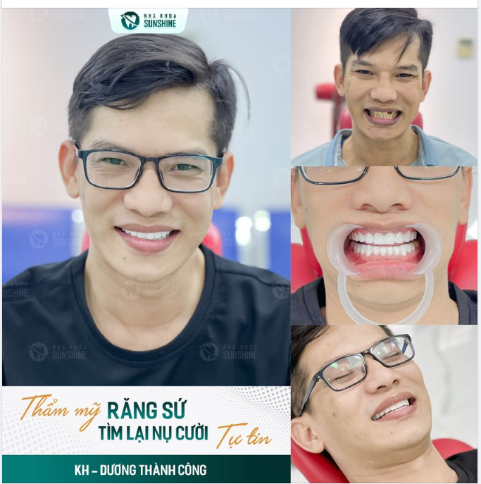 RĂNG SỨ TÌM LẠI NỤ CƯỜI TỰ TIN CHO KHÁCH HÀNG