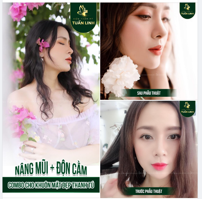 SAU 2 NĂM PHẪU THUẬT COMBO NÂNG MŨI + ĐỘN CẰM TẠI TUẤN LINH