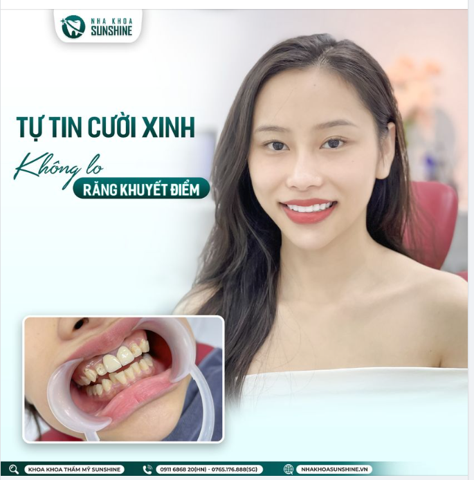 Sau khi được Bác sĩ thăm khám và tư vấn, chị đã quyết định chọn răng sứ Lava Plus để kiến tạo lại nụ cười của mình.