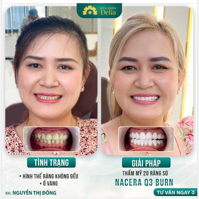 Sau khi thăm khám, bác sĩ Delia tư vấn thẩm mỹ 20 răng sứ Nacera Q3: