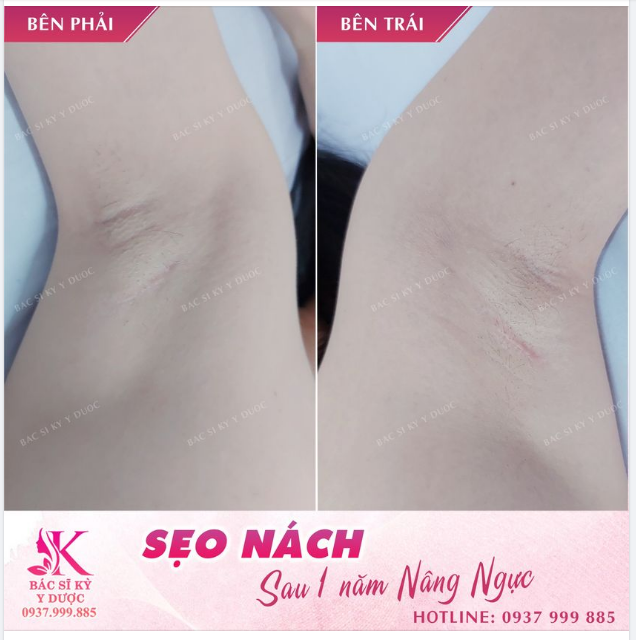 SẸＯ ＮÁCＨ ＮÂＮＧ ＮＧỰＣ SＡＵ ＭỘＴ ＮĂＭ