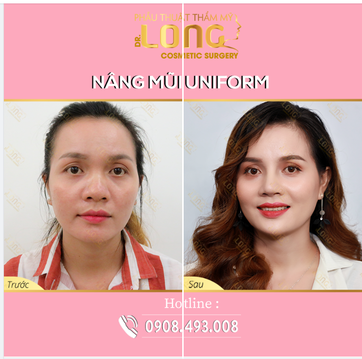 Sở hữu dáng mũi cao Tây, không chỉ giúp khách hàng nổi bật hơn trong mắt người khác mà còn thu hút tài lộc với thần thái sắc nét, sang chảnh từng góc cạnh.