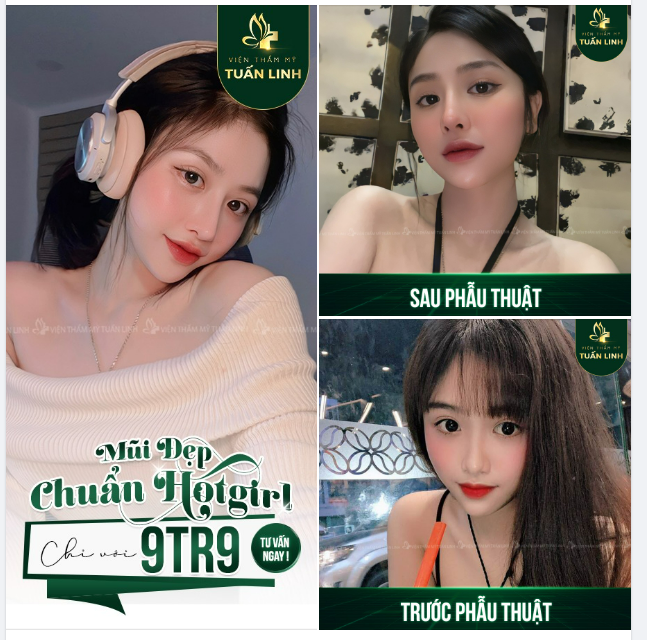 SỞ HỮU DÁNG MŨI ĐẸP CHUẨN HOTGIRL CHỈ VỚI 9tr9