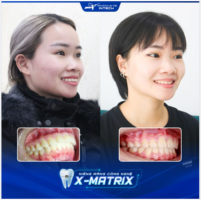 SỞ HỮU GƯƠNG MẶT V-LINE, NỤ CƯỜI ĐẠT CHUẨN SAU NIỀNG RĂNG X-MATRIX