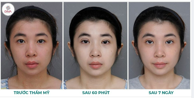 SỞ HỮU MẮT 2 MÍ TỰ NHIÊN SAU NHẤN MÍ