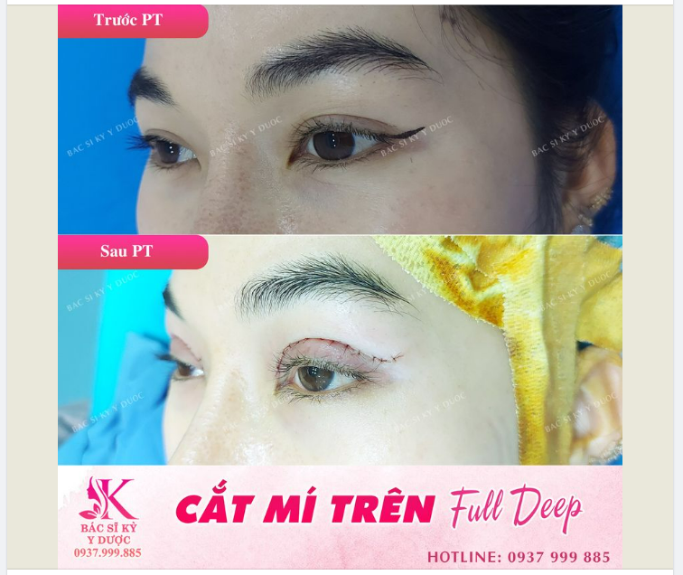 Sở hữu ngay MẮT TO TRÒN - NẾP MÍ ĐẸP TỰ NHIÊN với công nghệ cắt mí 4in1 tại Bác sĩ Kỳ y dược