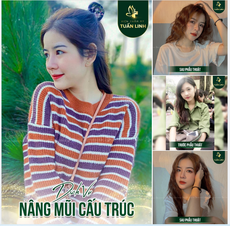 SỞ HỮU VẺ ĐẸP THANH TÚ CHỈ VỚI NÂNG MŨI CẤU TRÚC
