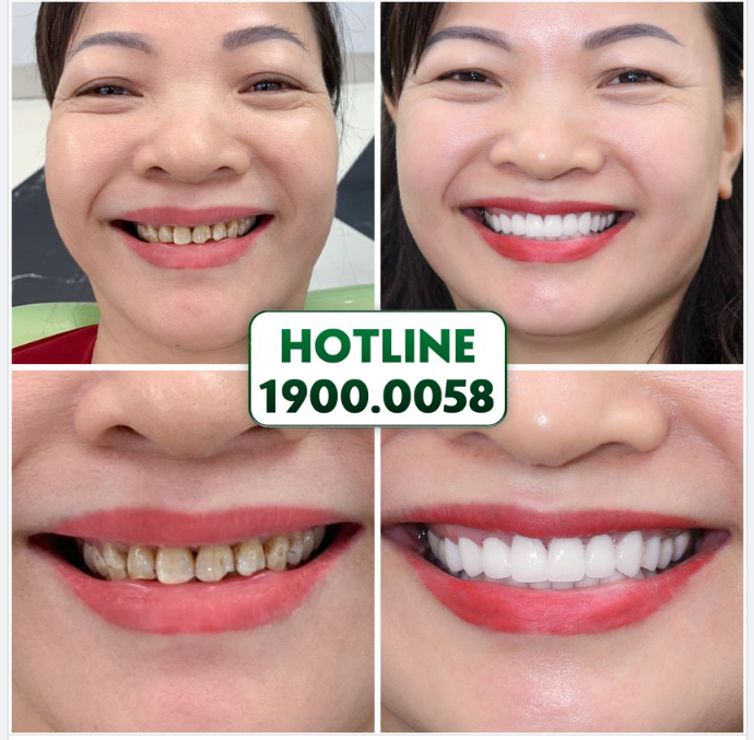 Sống trong cảnh răng xấu hàng chục năm khiến chị Tám luôn cảm thấy thiếu tự tin, ngại giao tiếp.