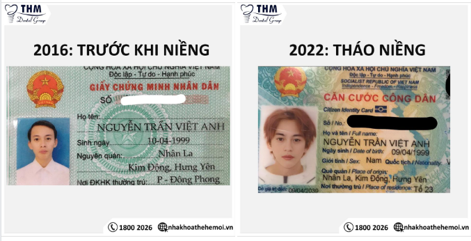SỰ ẢO DIỆU CỦA NIỀNG RĂNG MANG LẠI