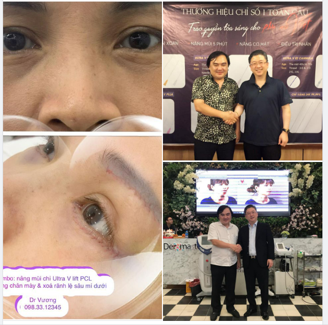 SỬ DỤNG CHỈ SINH HỌC VỚI DR VƯƠNG