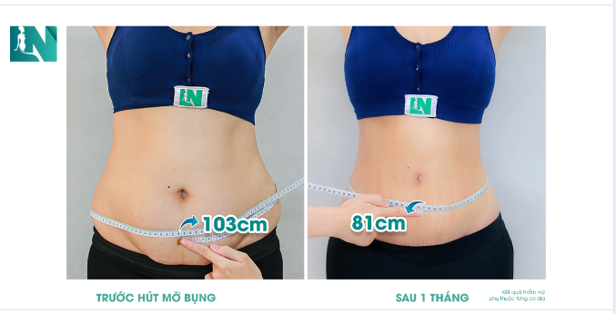 Sự thay đổi của dáng vóc sau 1 tháng  hút mỡ tạo dáng thẩm mỹ như thế nào?