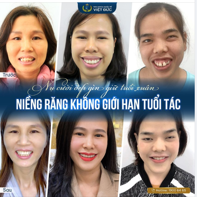 SỰ VI DIỆU CỦA NIỀNG RĂNG
