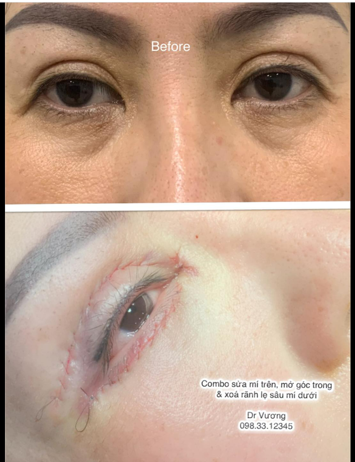 Sửa mí trên (bị lệch, đuôi sệ), mở góc trong & xoá rãnh lệ sâu mí dưới cho chị khách Việt kiều từ Canada !