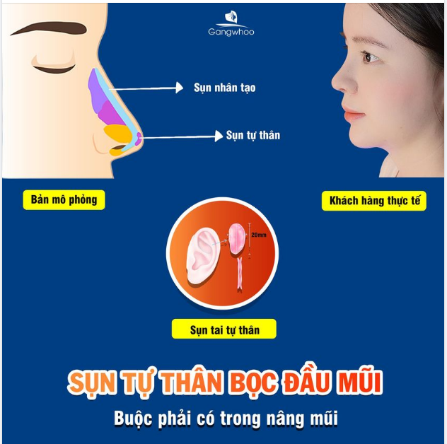 SỤN TỰ THÂN BỌC ĐẦU MŨI - VÌ SAO BUỘC PHẢI CÓ TRONG NÂNG MŨI