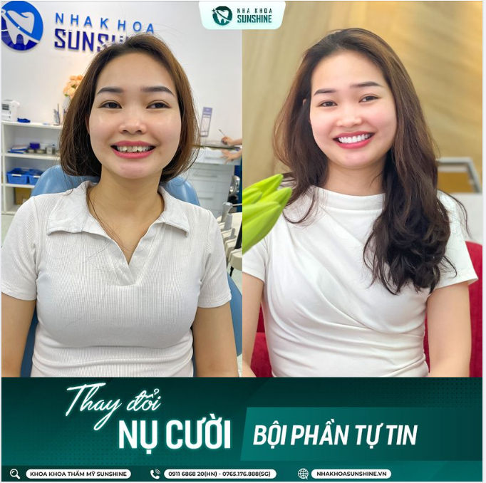 SUNSHINE -  THAY ĐỔI NỤ CƯỜI – THAY ĐỔI CUỘC SỐNG.