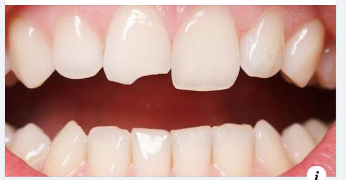 Sứt mẻ răng, khắc phục thế nào?