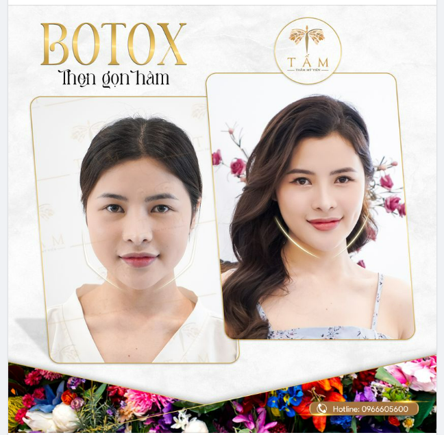 T.iêm botox gọn hàm có hiệu quả không