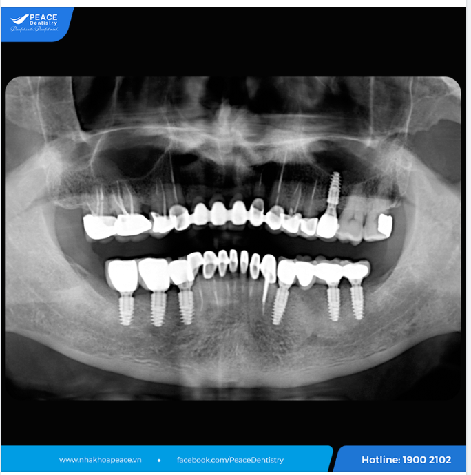 TÁI KHÁM ĐỊNH KỲ - BÍ QUYẾT BẢO VỆ RĂNG IMPLANT CHẮC KHỎE ỔN ĐỊNH LÂU DÀI