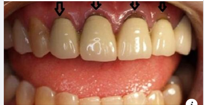 TẠI SAO LÀM RĂNG SỨ XONG LẠI BỊ HỞ CHÂN RĂNG?