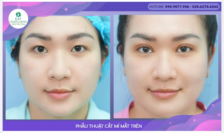 Tại sao nhiều bạn trẻ lại cần phẫu thuật cắt mí trên mà không thể bấm mí