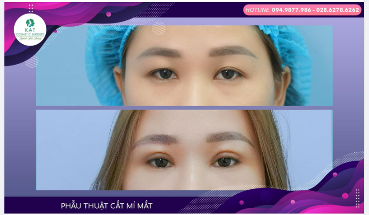 Tại sao nhiều bạn trẻ lại cần phẫu thuật cắt mí trển mà không thể bấm mí