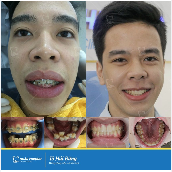 Tại sao răng khấp khểnh lại nên niềng sớm