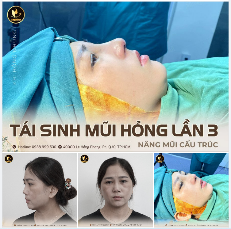 TÁI SINH MŨI HỎNG LẦN 3