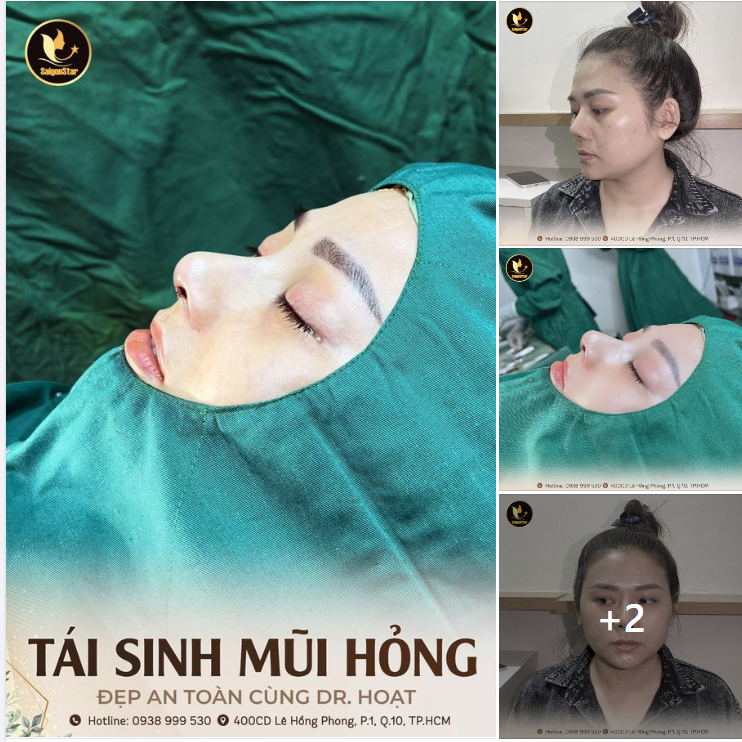 TÁI SINH MŨI HỎNG ĐẸP AN TOÀN CÙNG DR. HOẠT